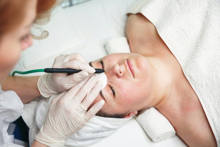 Electrocoagulation of vascular sprockets without scars and traces