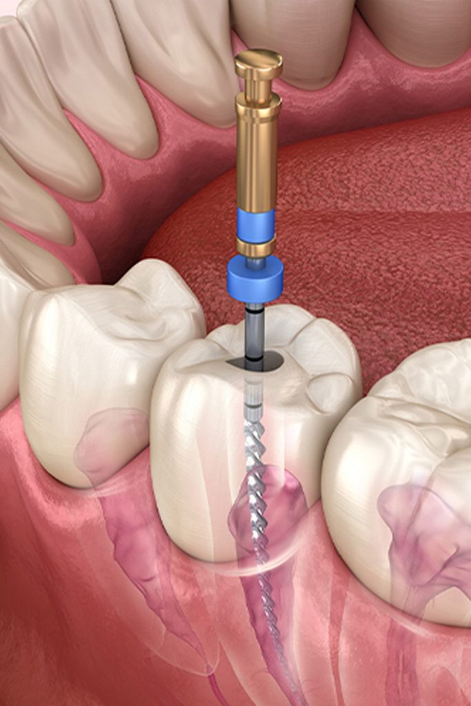 Best Root Canal Treatment Egypt