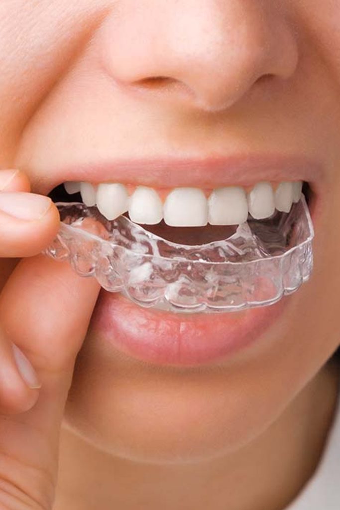 Best Transparent Aligners Clinic Egypt