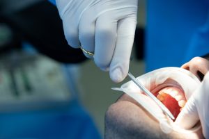Best Root Canal Treatment Egypt
