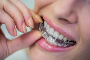 Best Transparent Aligners Clinic Egypt